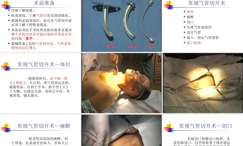 气管切开术进展.ppt
