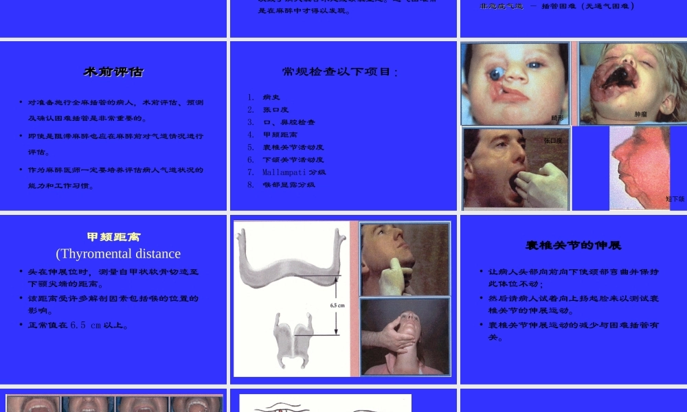 气管插管及困难气道的处理.ppt