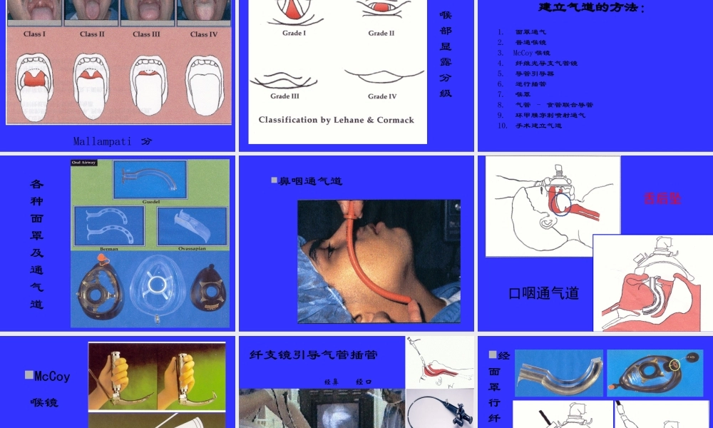 气管插管及困难气道的处理.ppt