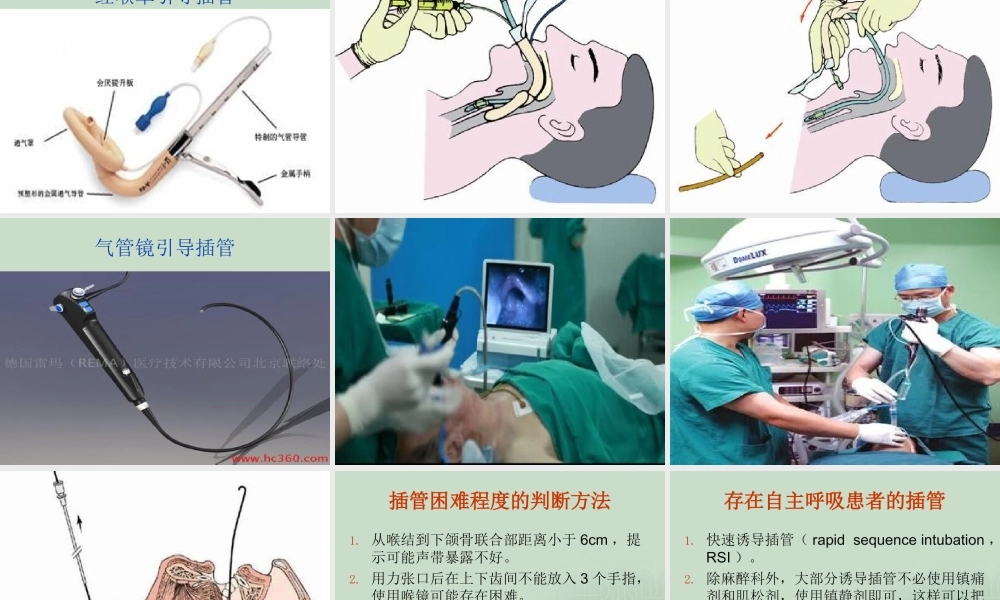 气管插管术.ppt