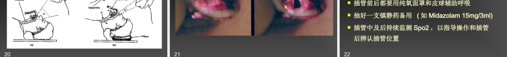 气管插管的作用.ppt