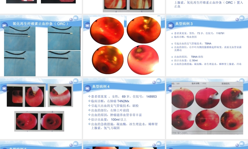 气管镜介入相关大出血处理策略.ppt