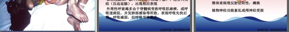 流行性乙型脑炎-运城传染病医院-卫志干研究.ppt