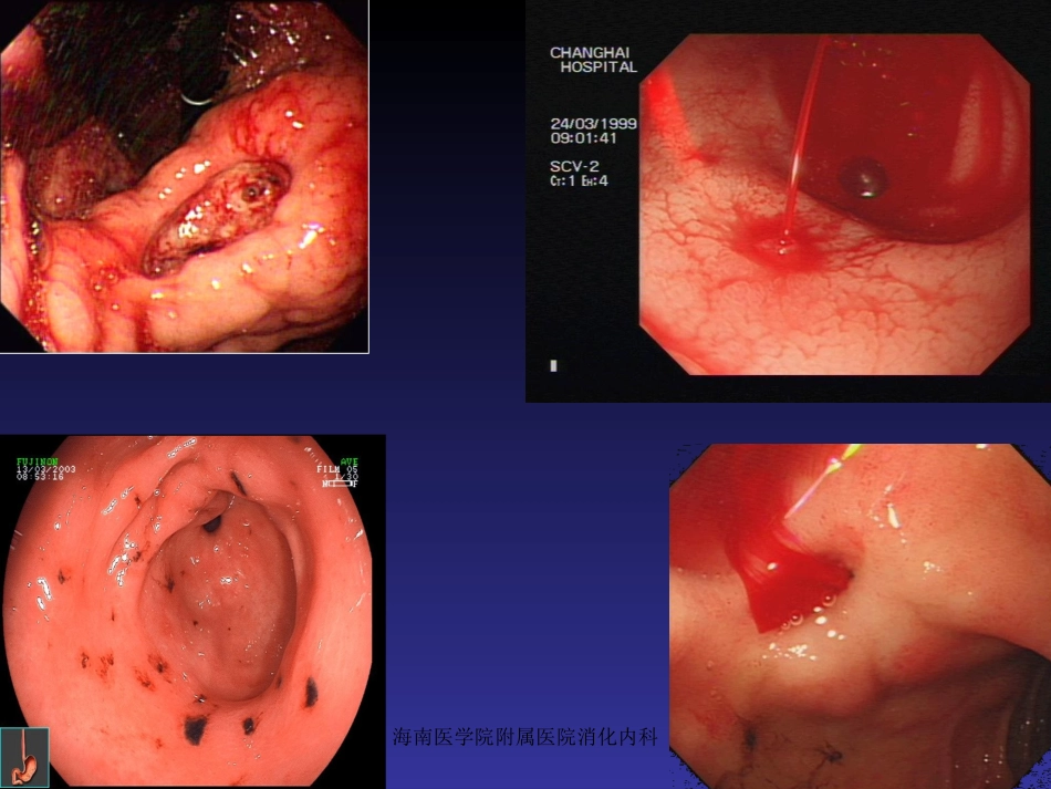 胃十二指肠出血.ppt_第2页