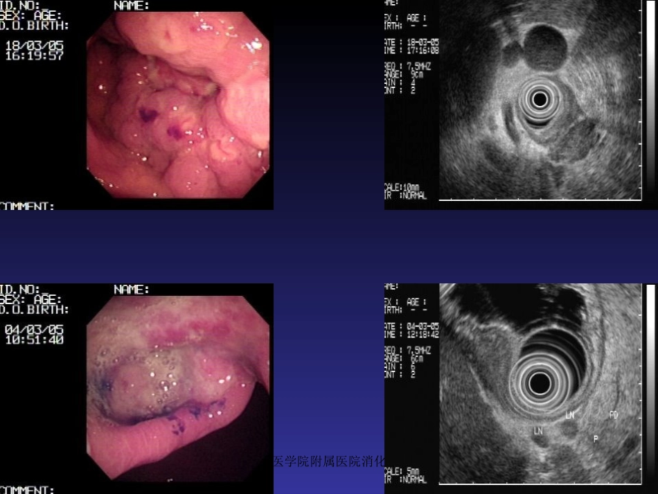 胃十二指肠出血.ppt_第3页