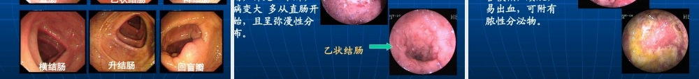 溃疡性结肠炎.ppt