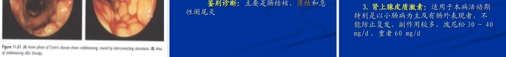 炎症性肠病--可罗恩病2013.ppt