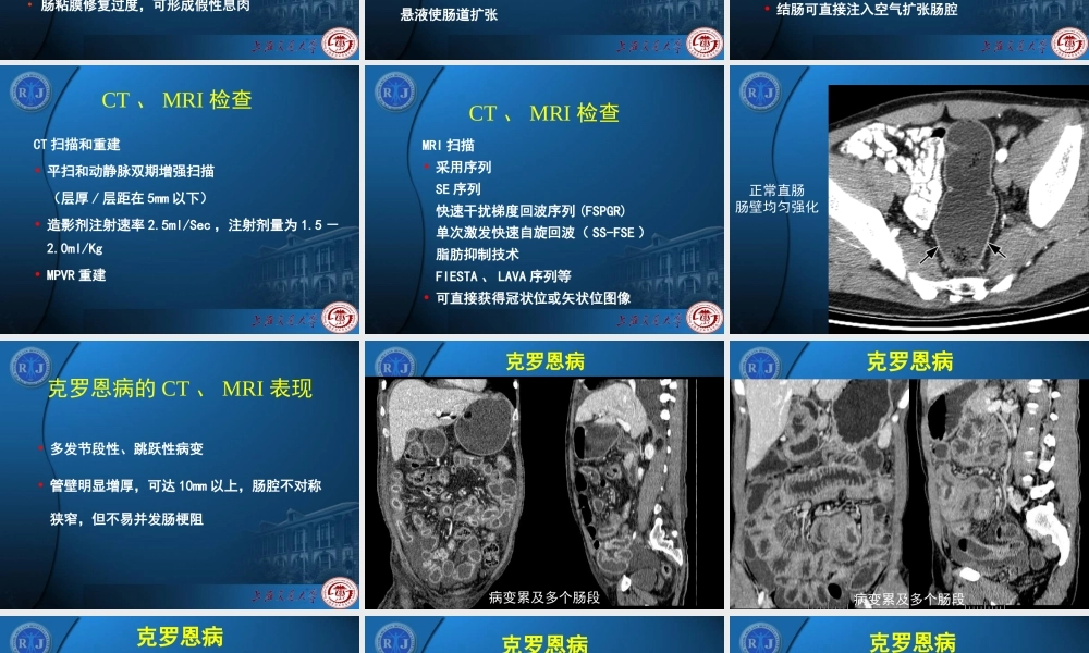 炎症性肠病影像学表现.ppt