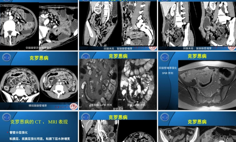 炎症性肠病影像学表现.ppt