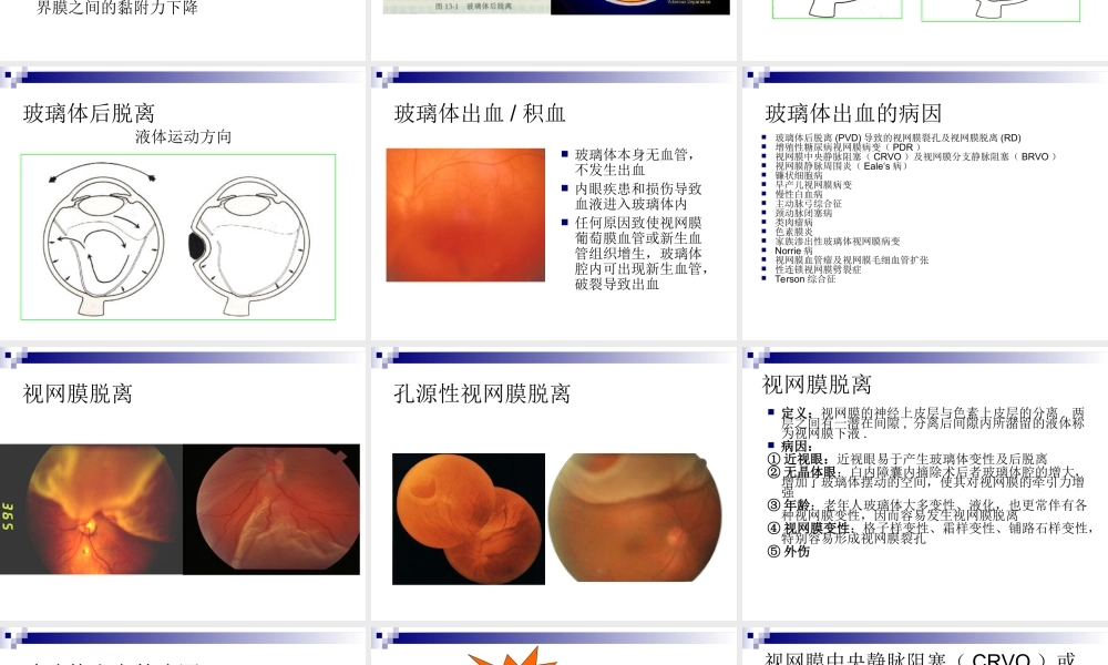 玻璃体液化及玻璃体积血概要.ppt