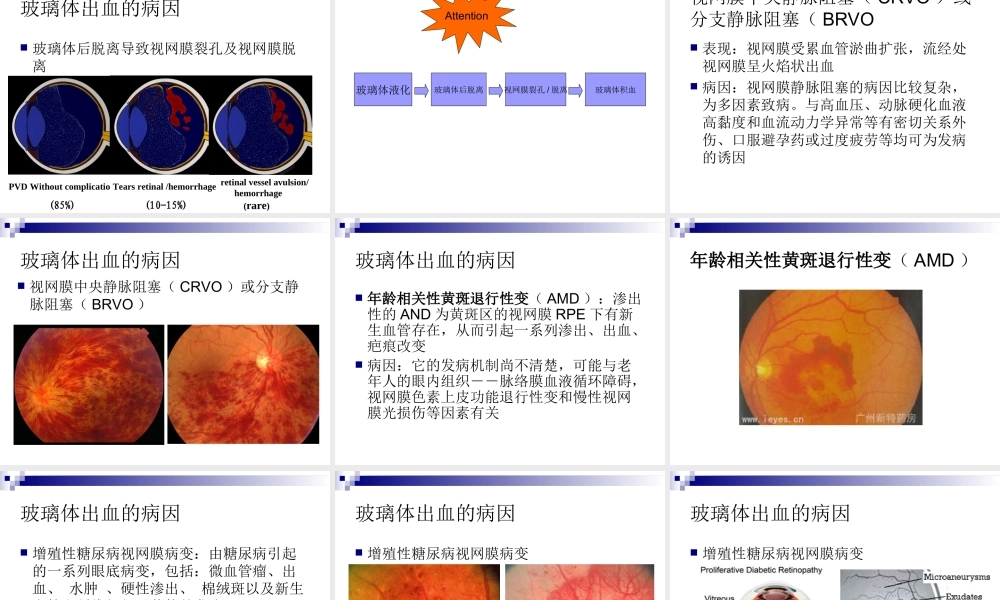 玻璃体液化及玻璃体积血概要.ppt