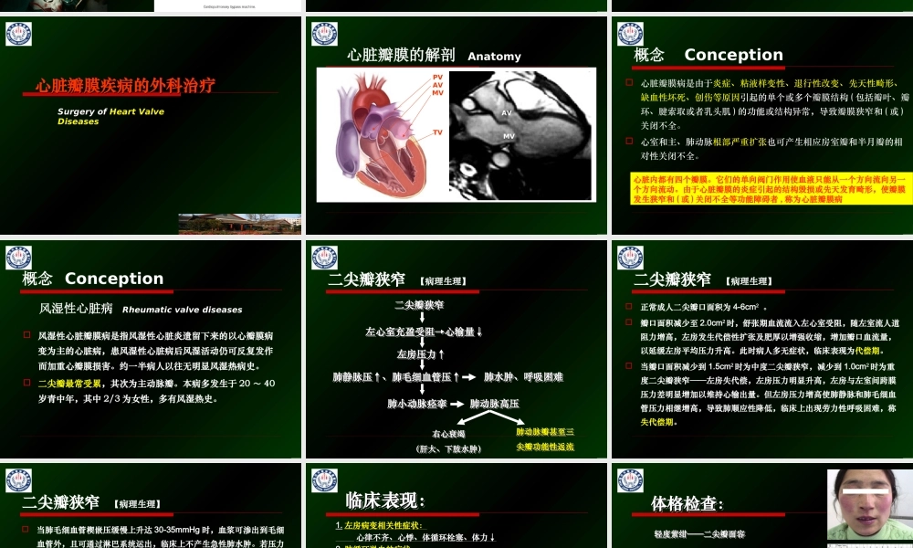 瓣膜和先心病【外科】-郭应强.ppt