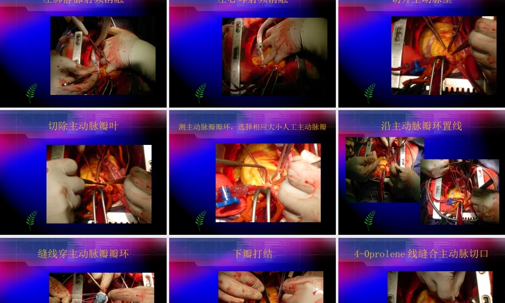 瓣膜替换术的术中配合.ppt