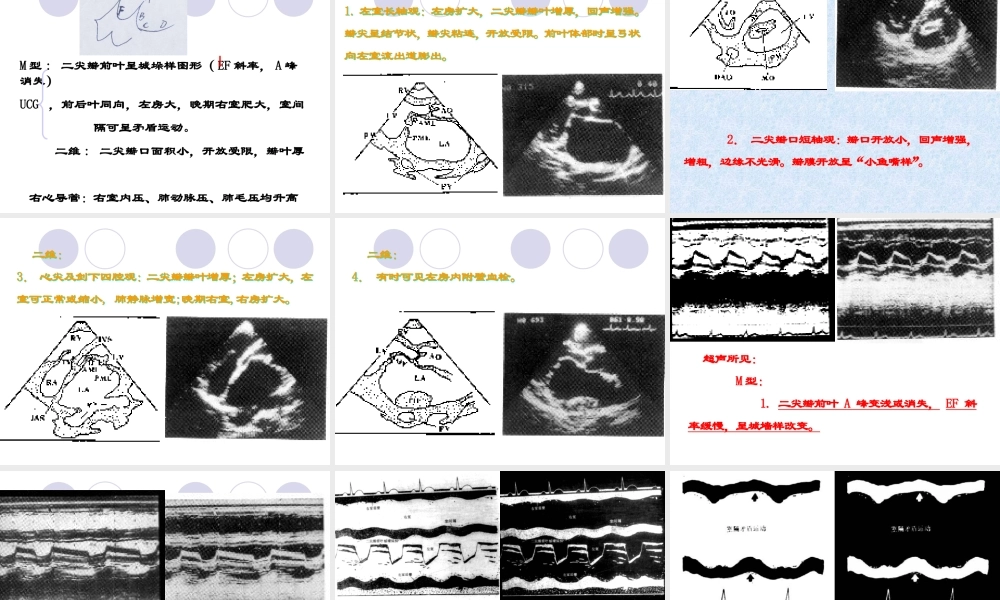瓣膜病zhihong.ppt