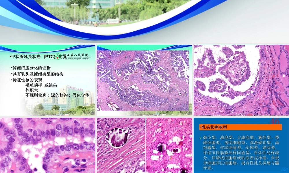 甲状腺乳头状癌-ppt-(1).ppt