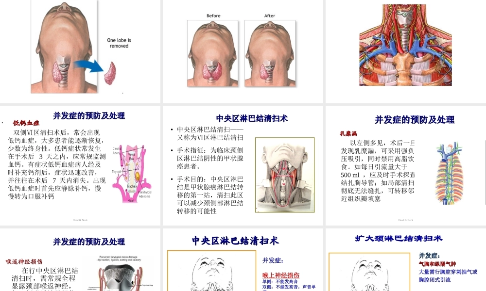 甲状腺切除术.ppt.ppt