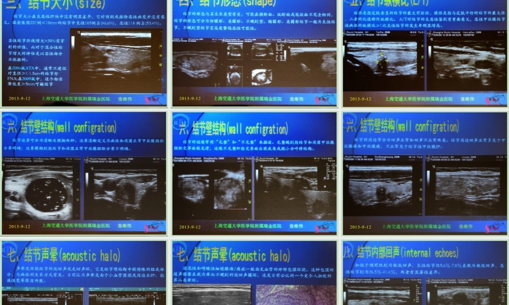 甲状腺结节超声规范及其新进展.ppt