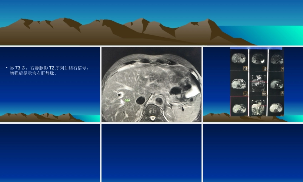 男73岁右肝静脉如结石.ppt