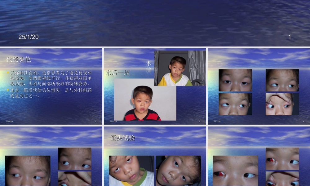 眼外肌麻痹引起的代偿头位.ppt
