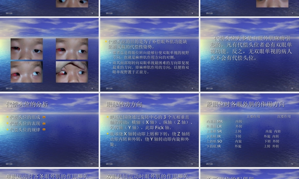 眼外肌麻痹引起的代偿头位.ppt