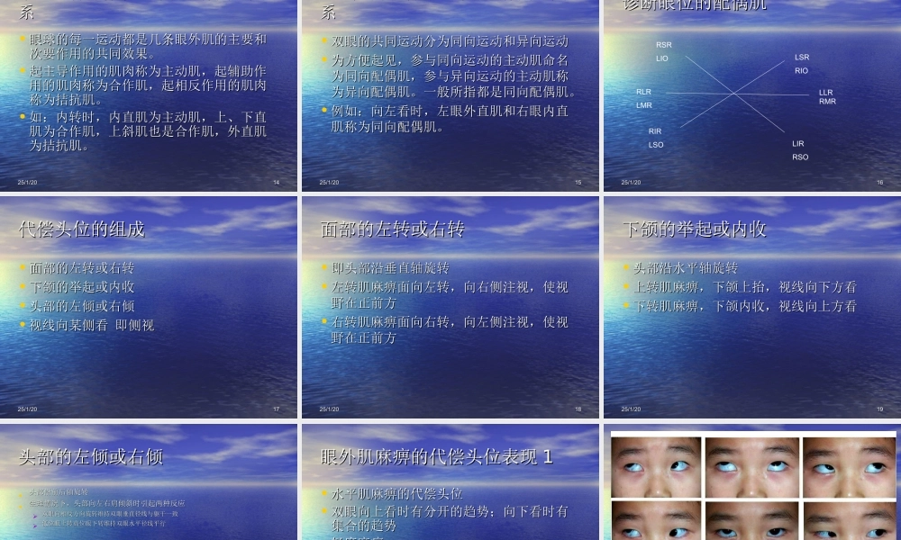眼外肌麻痹引起的代偿头位.ppt