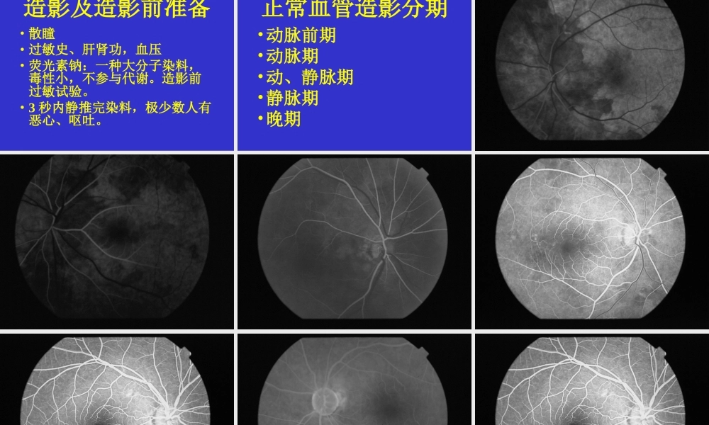 眼底血管荧光造影.ppt