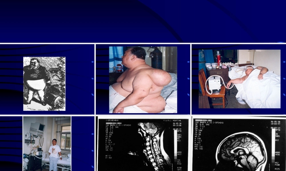 睡眠呼吸暂停的诊治.ppt