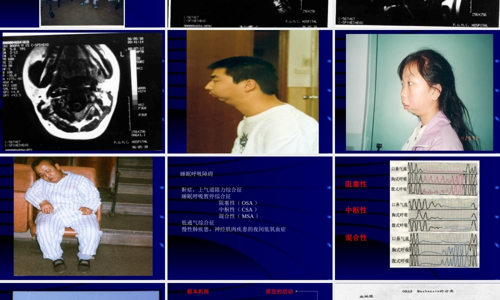 睡眠呼吸暂停的诊治.ppt