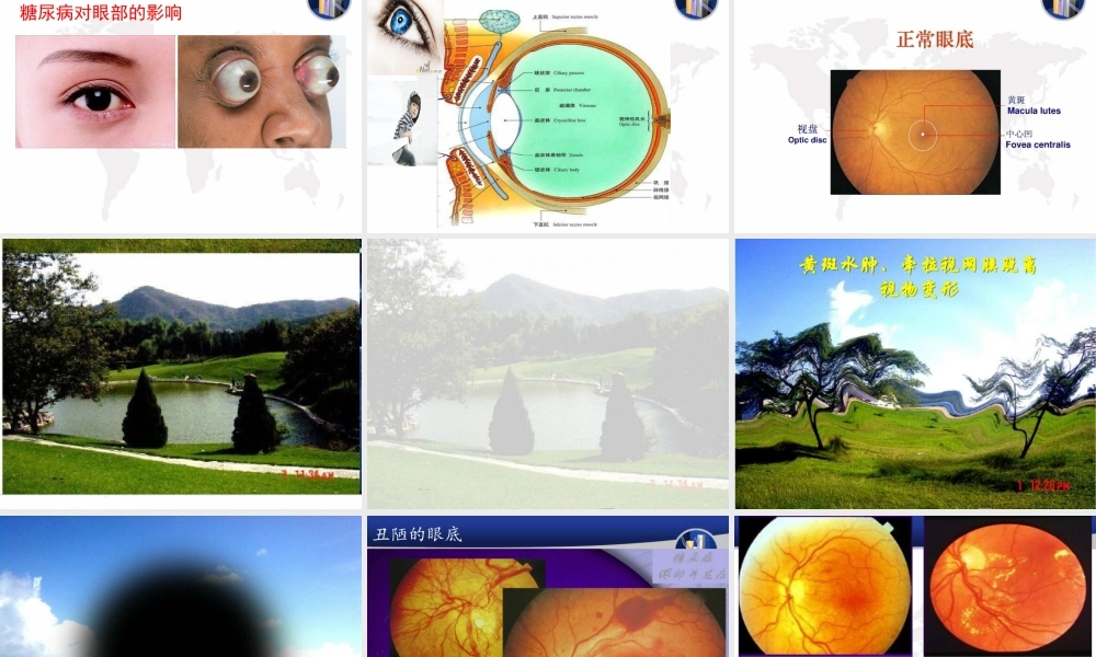 糖尿病性微血管并发症.ppt