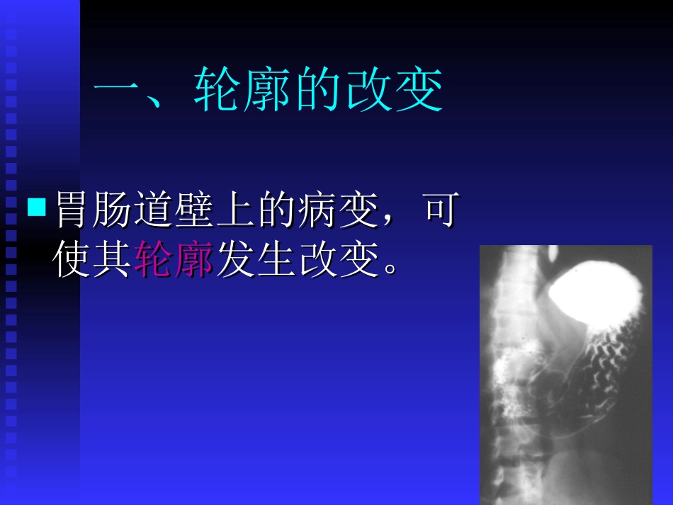 消化系统基本病变的X线表现.ppt_第3页