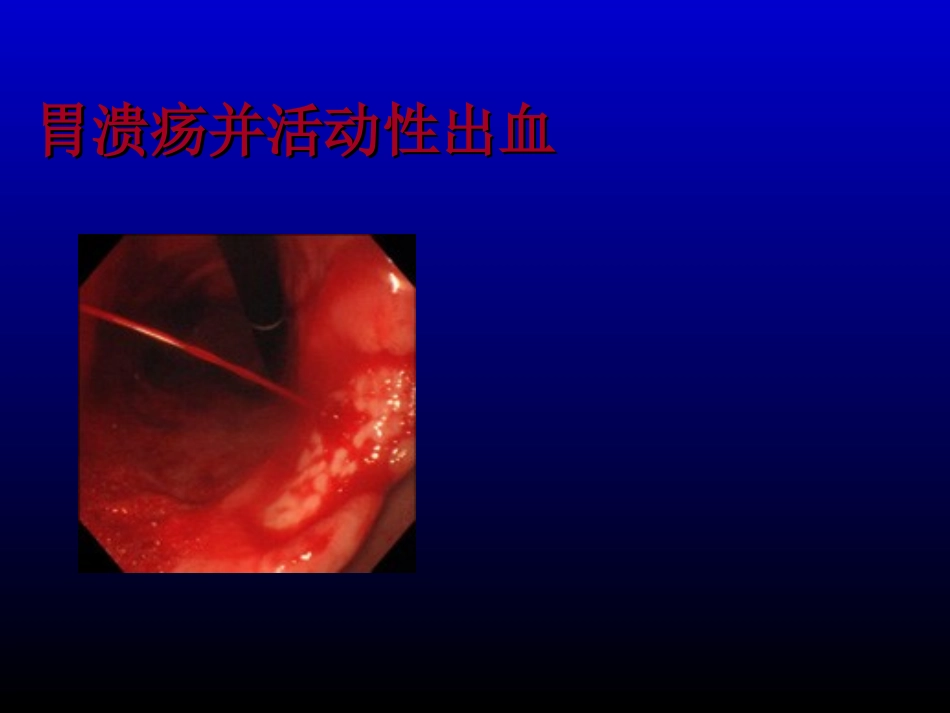 消化道出血人卫版bytjw.ppt_第3页
