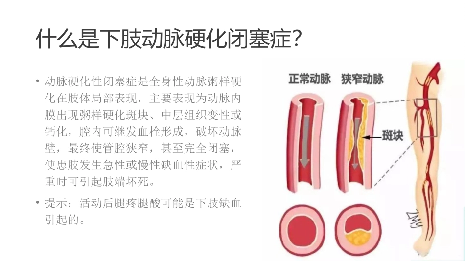 王丽艳(王俪艳)提示中老年腿疼腿酸别忽视-警惕下肢动脉硬化闭塞症.pptx_第3页