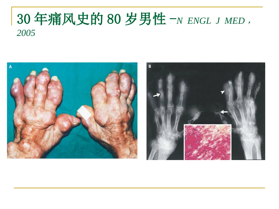 痛风的诊治进展.ppt_第2页