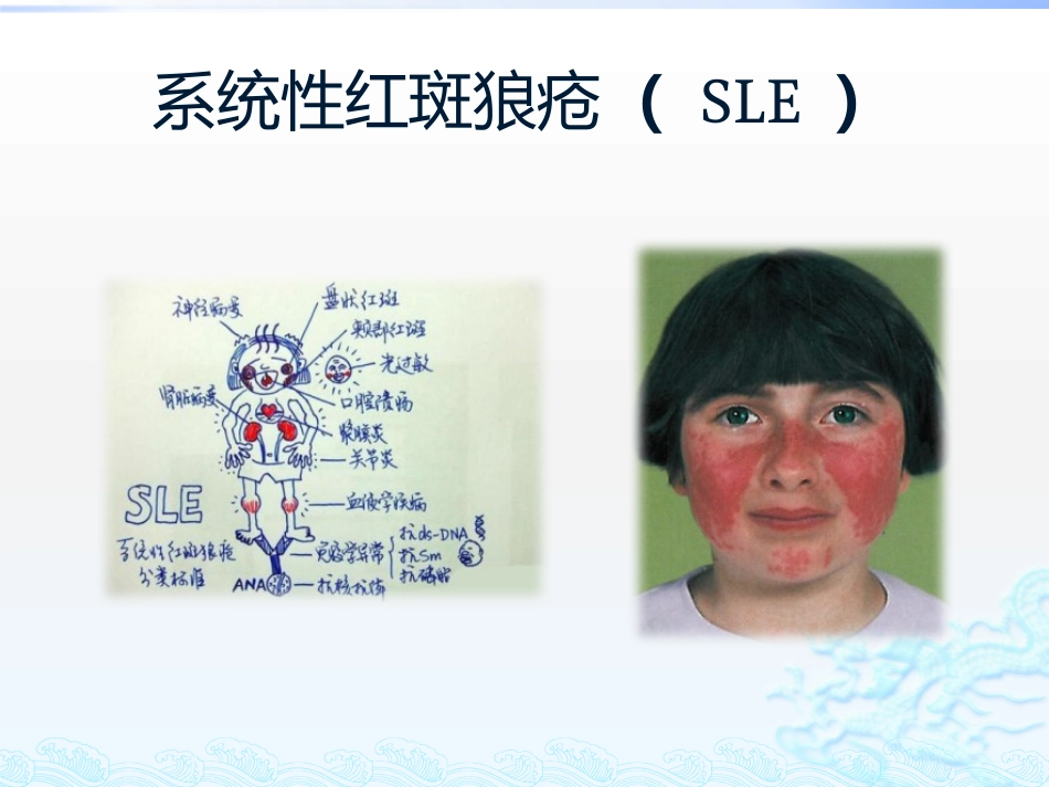 系统性红斑狼疮相关股骨头坏死.pptx_第2页