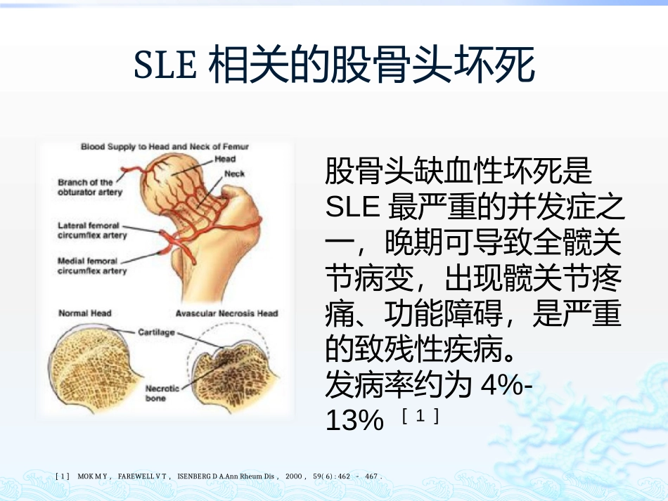 系统性红斑狼疮相关股骨头坏死.pptx_第3页