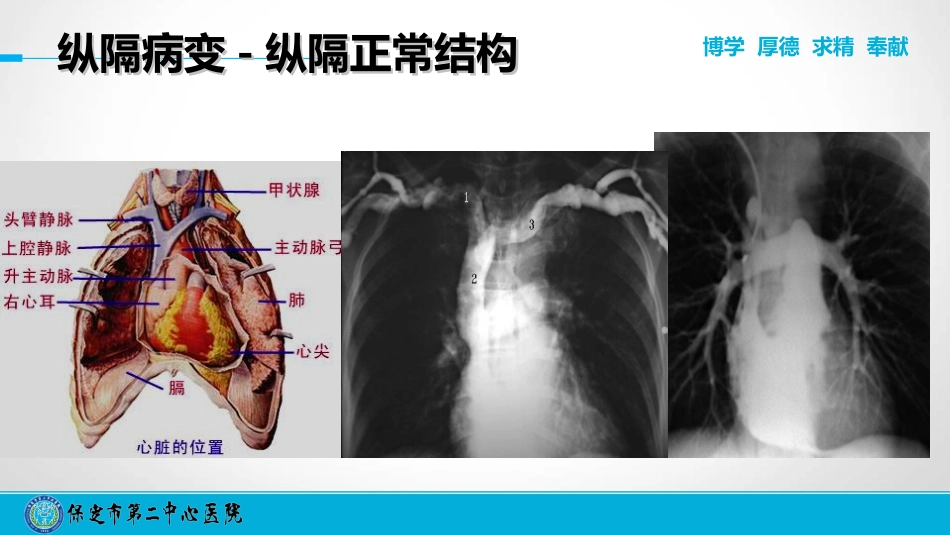胸片读片技巧下.ppt_第3页