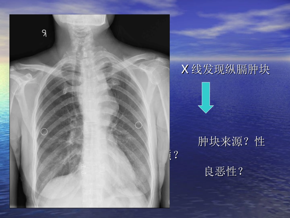胸内甲状腺肿.ppt_第2页