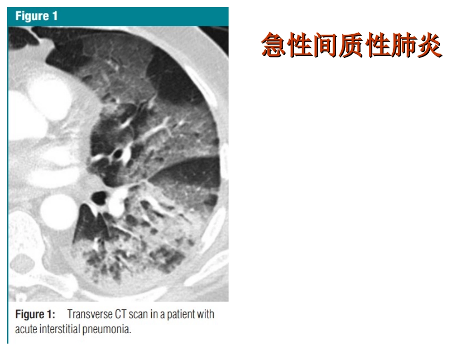胸部影像学.ppt_第3页