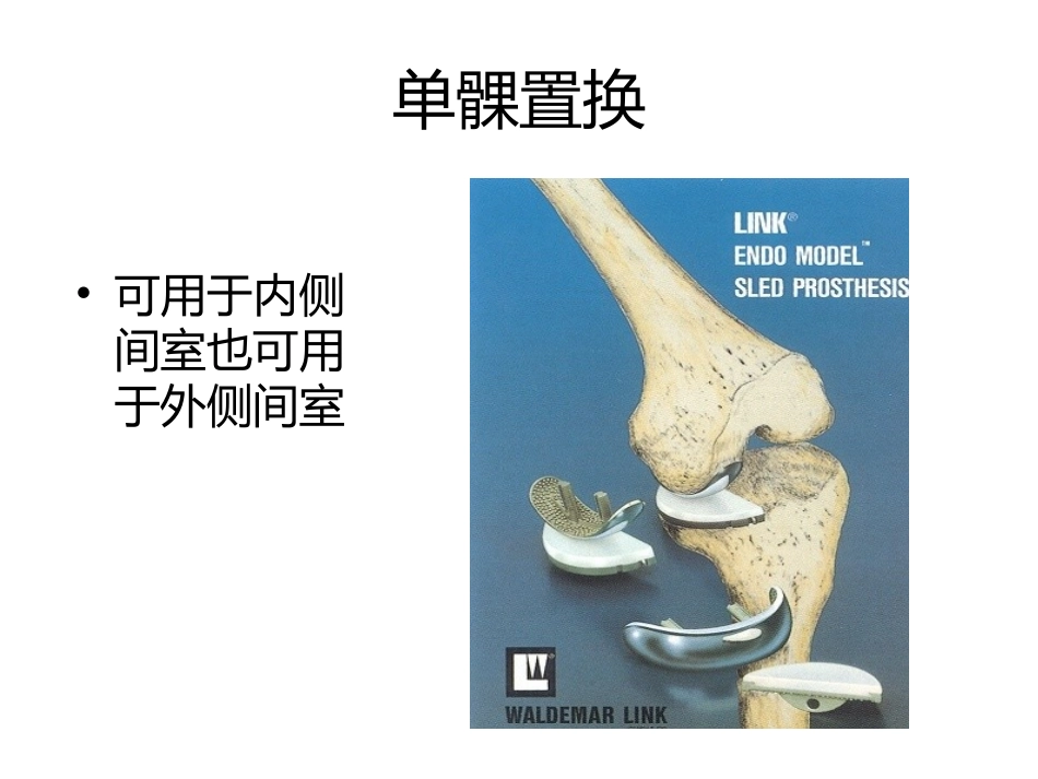 膝关节单髁置换.pptx_第2页