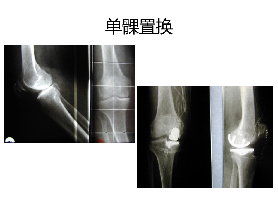 膝关节单髁置换.pptx_第3页