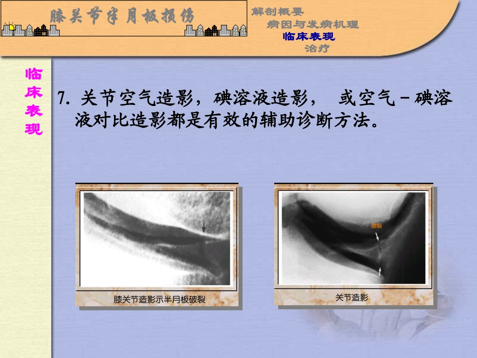 膝关节半月板损伤.ppt_第3页