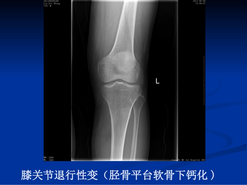 膝关节骨性关节炎介绍.ppt_第2页