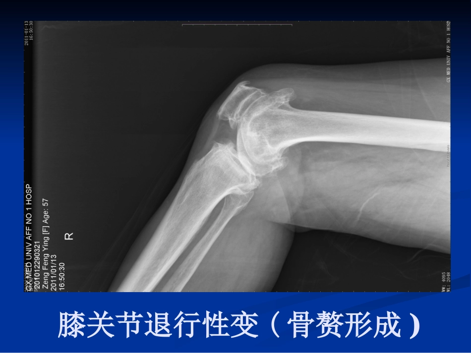 膝关节骨性关节炎介绍.ppt_第3页