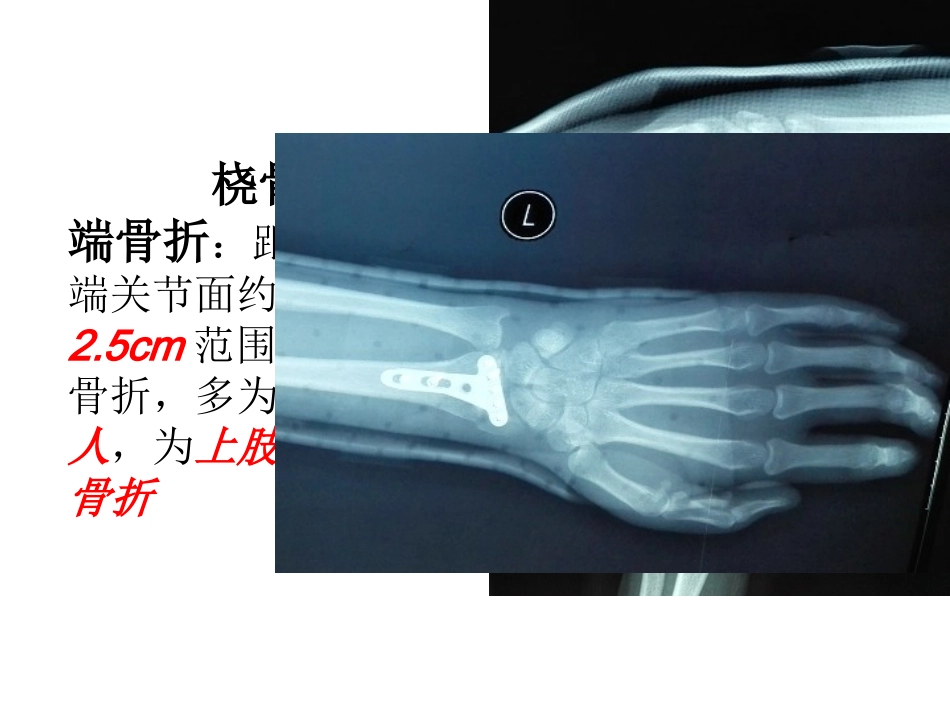 腕关节康复.pptx_第2页