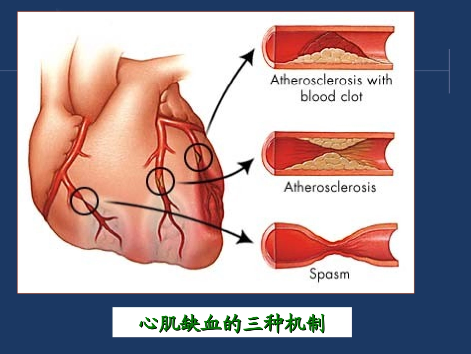 西药综合-第十章-冠状动脉粥样硬化性心脏病.ppt_第3页