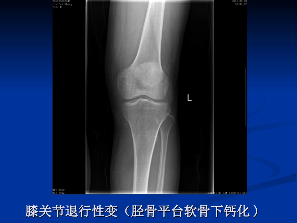 膝关节骨性关节炎资料.ppt_第2页