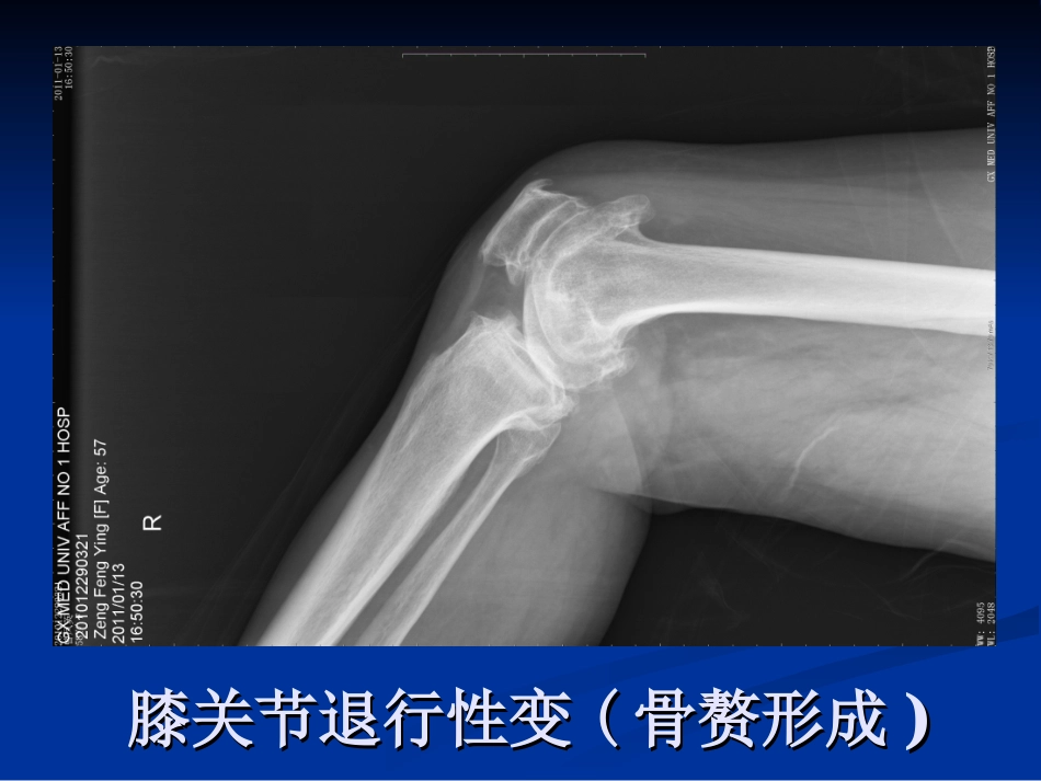 膝关节骨性关节炎资料.ppt_第3页