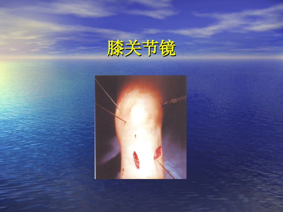 膝关节镜.ppt_第1页