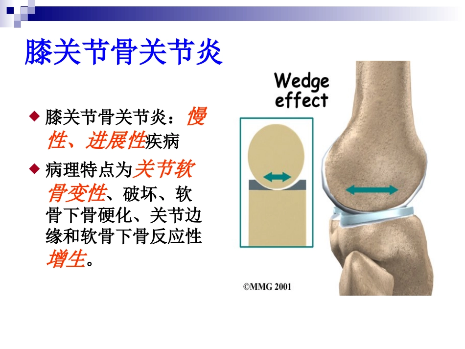 膝骨关节炎的防治.ppt_第2页