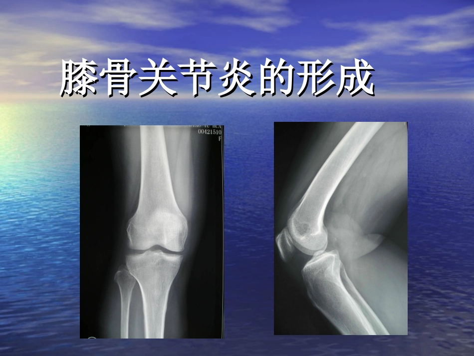 膝骨关节炎健康宣教.ppt_第3页